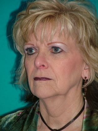 Mini Facelift: Case 5 - Before