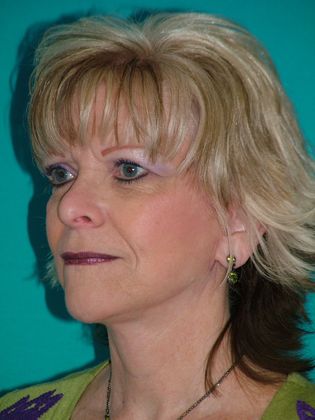 Mini Facelift: Case 5 - After