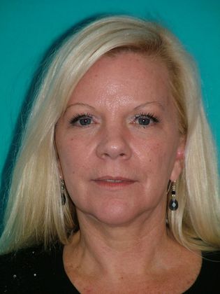 Mini Facelift Case 7 - Before