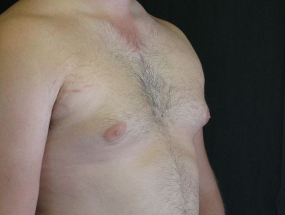 Gynecomastia (male large breasts): Case 1 - before