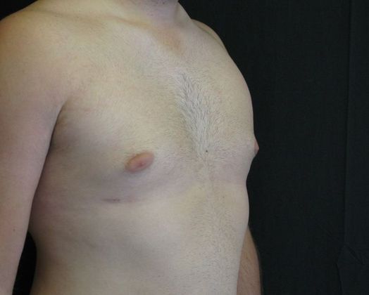 Gynecomastia (male large breasts): Case 1 - after 8 months