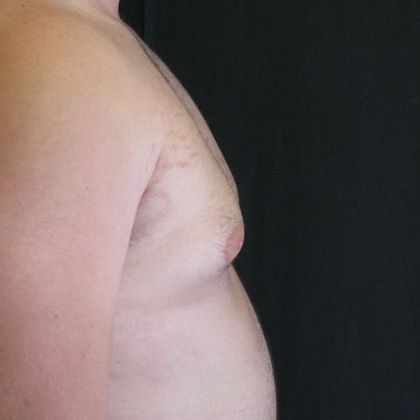 Gynecomastia (male large breasts): Case 1 - before