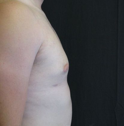 Gynecomastia (male large breasts): Case 1 - after 8 months