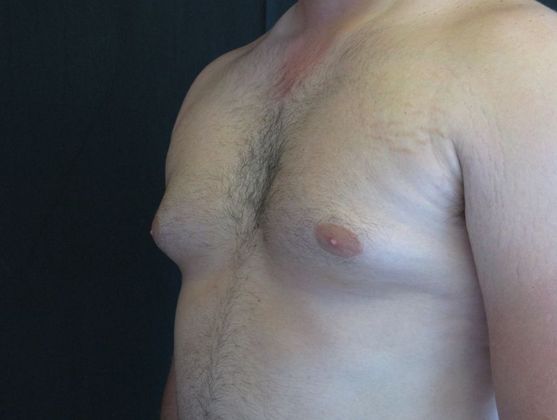 Gynecomastia (male large breasts): Case 1 - before