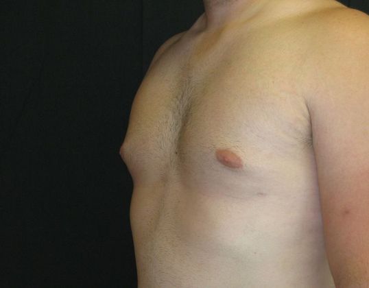 Gynecomastia (male large breasts): Case 1 - after 8 months