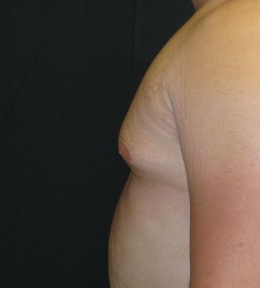 Gynecomastia (male large breasts): Case 1 - before
