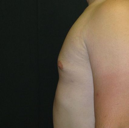 Gynecomastia (male large breasts): Case 1 - after 8 months