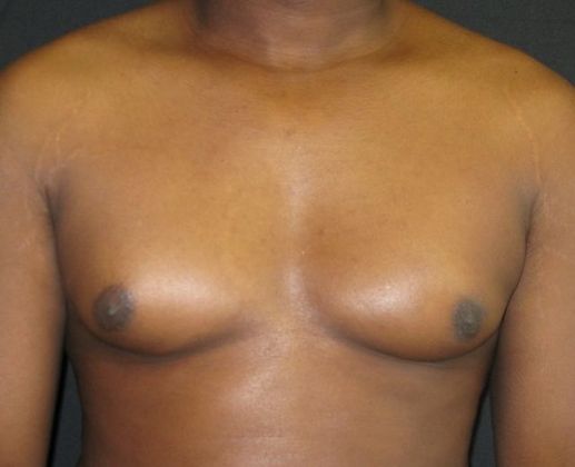 Gynecomastia (male large breasts) Case 2 - Before