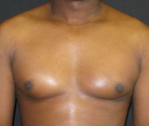 Gynecomastia (male large breasts) Case 2 - After