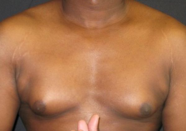 Gynecomastia (male large breasts): Case 2 - before with pectoralis contraction
