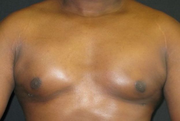 Gynecomastia (male large breasts): Case 2 - after 4 months with pectoralis contraction