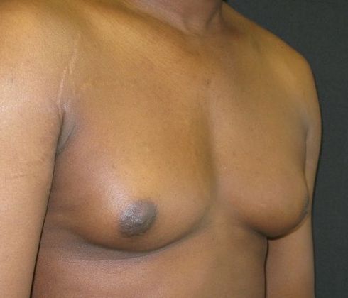 Gynecomastia (male large breasts): Case 2 - before