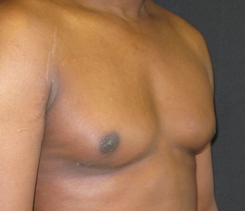 Gynecomastia (male large breasts): Case 2 - after 4 months