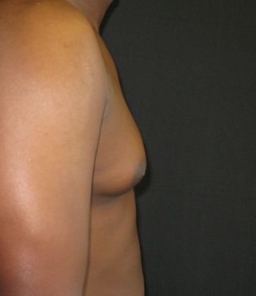 Gynecomastia (male large breasts): Case 2 - before