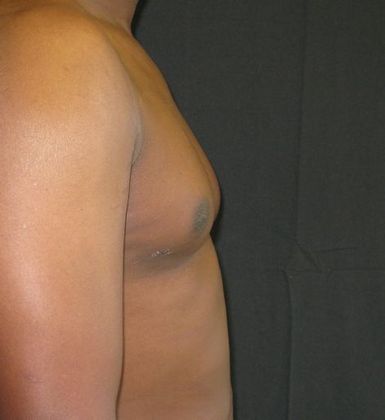 Gynecomastia (male large breasts): Case 2 - after 4 months