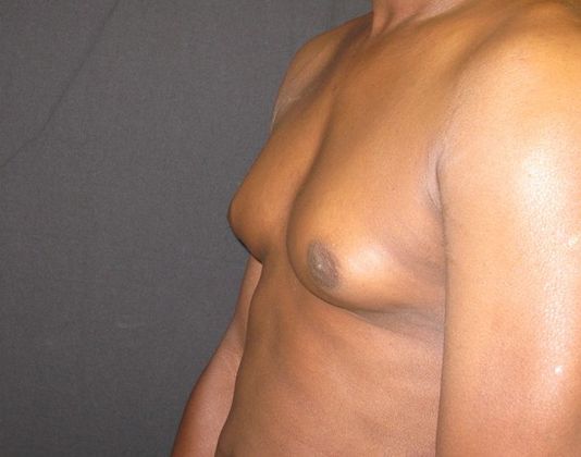 Gynecomastia (male large breasts): Case 2 - before