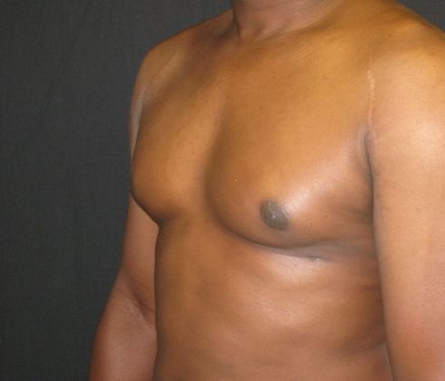 Gynecomastia (male large breasts): Case 2 - after 4 months
