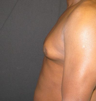 Gynecomastia (male large breasts): Case 2 - before