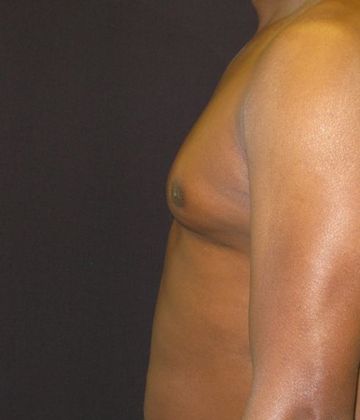 Gynecomastia (male large breasts): Case 2 - after 4 months