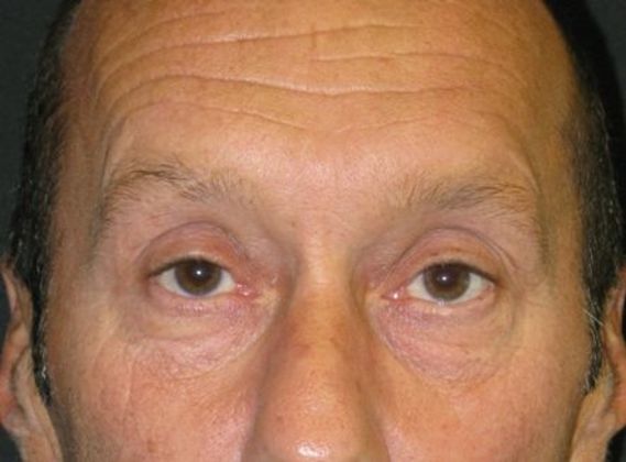 blepharoplasty (eyelid lift): Case 3 - before
