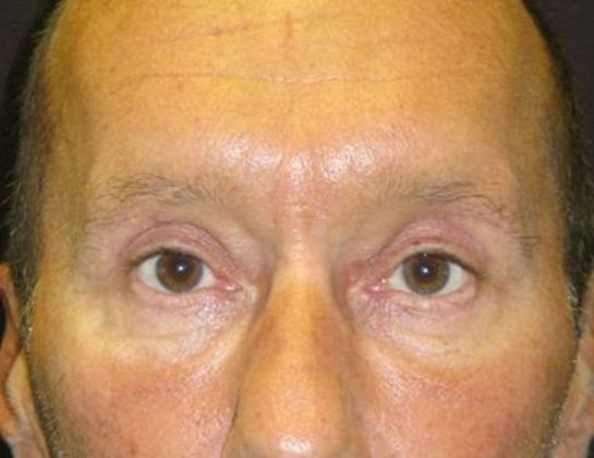 blepharoplasty (eyelid lift): Case 3 - after 4 months