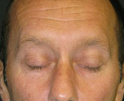 blepharoplasty (eyelid lift): Case 3 - before upper eyelid skin excess