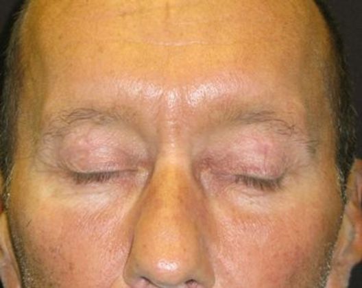 blepharoplasty (eyelid lift): Case 3 - after 4 months scar almost invisible