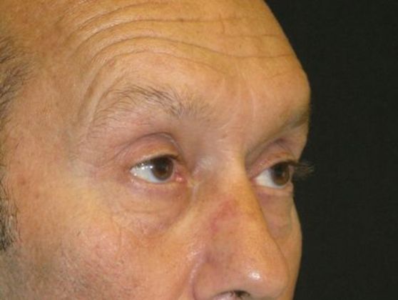 blepharoplasty (eyelid lift): Case 3 - before