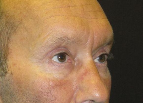 blepharoplasty (eyelid lift): Case 3 - after 4 months