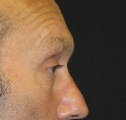 blepharoplasty (eyelid lift): Case 3 - before