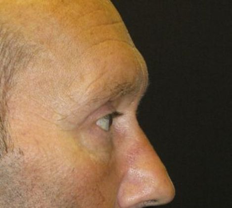 blepharoplasty (eyelid lift): Case 3 - after 4 months better cheek contour
