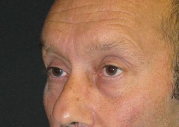 blepharoplasty (eyelid lift): Case 3 - before