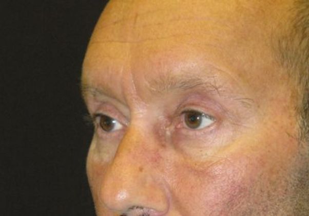 blepharoplasty (eyelid lift): Case 3 - after 4 months