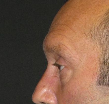 blepharoplasty (eyelid lift): Case 3 - before