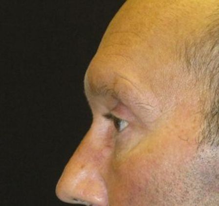 blepharoplasty (eyelid lift): Case 3 - after 4 months improved cheek contour