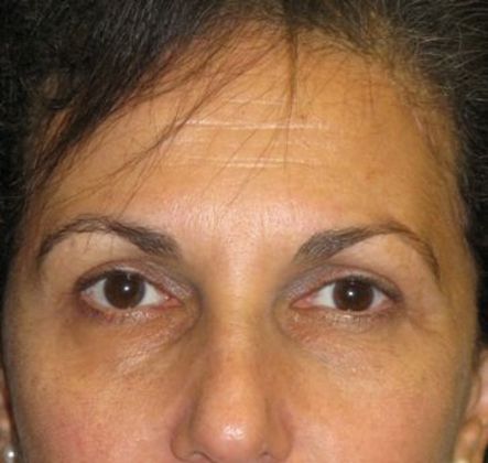 blepharoplasty (eyelid lift) Case 4 - After