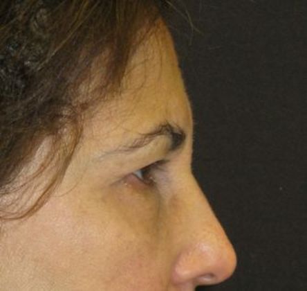blepharoplasty (eyelid lift): Case 4 - before