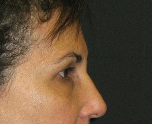 blepharoplasty (eyelid lift): Case 4 - after 4 months