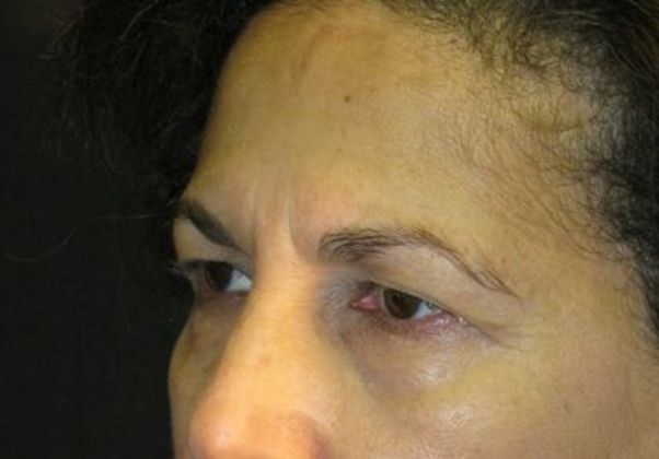 blepharoplasty (eyelid lift): Case 4 - before