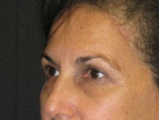 blepharoplasty (eyelid lift): Case 4 - after 4 months