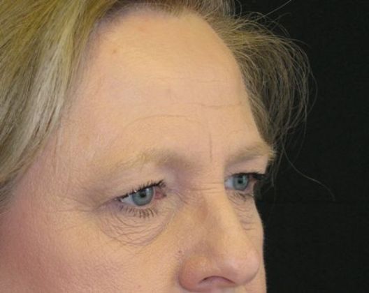 blepharoplasty (eyelid lift): Case 5 - before