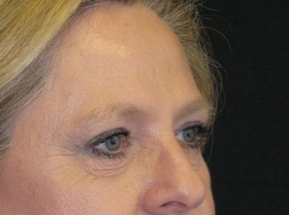 blepharoplasty (eyelid lift): Case 5 - after 8 months