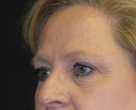 blepharoplasty (eyelid lift): Case 5 - after 8 months