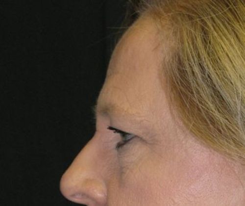 blepharoplasty (eyelid lift): Case 5 - before