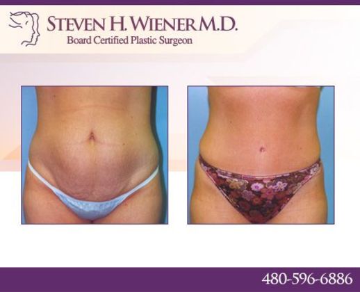 Liposuction: Case 1 - BEFORE AND AFTER