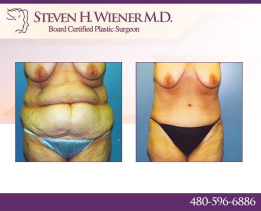 Tummy Tuck: Case 1 - BEFORE AND AFTER