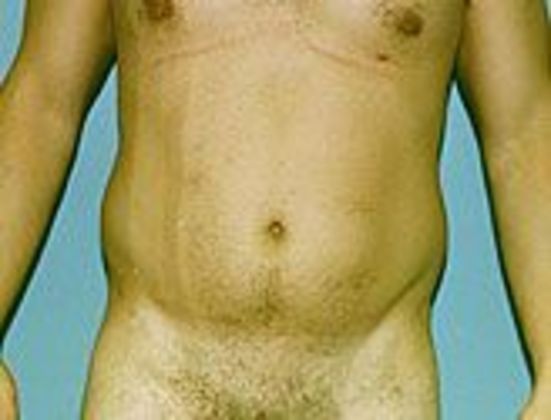 Tummy Tuck: Case 1 - BEFORE