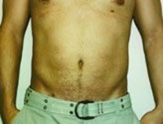 Tummy Tuck: Case 1 - AFTER