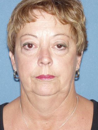 Chin Augmentation Case 2 - Before