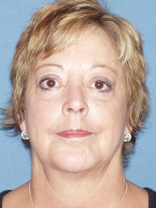 Chin Augmentation Case 2 - After